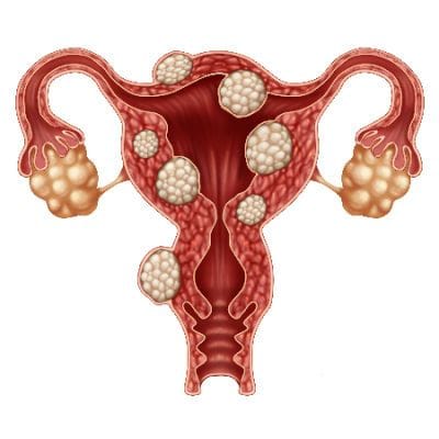 fibroids