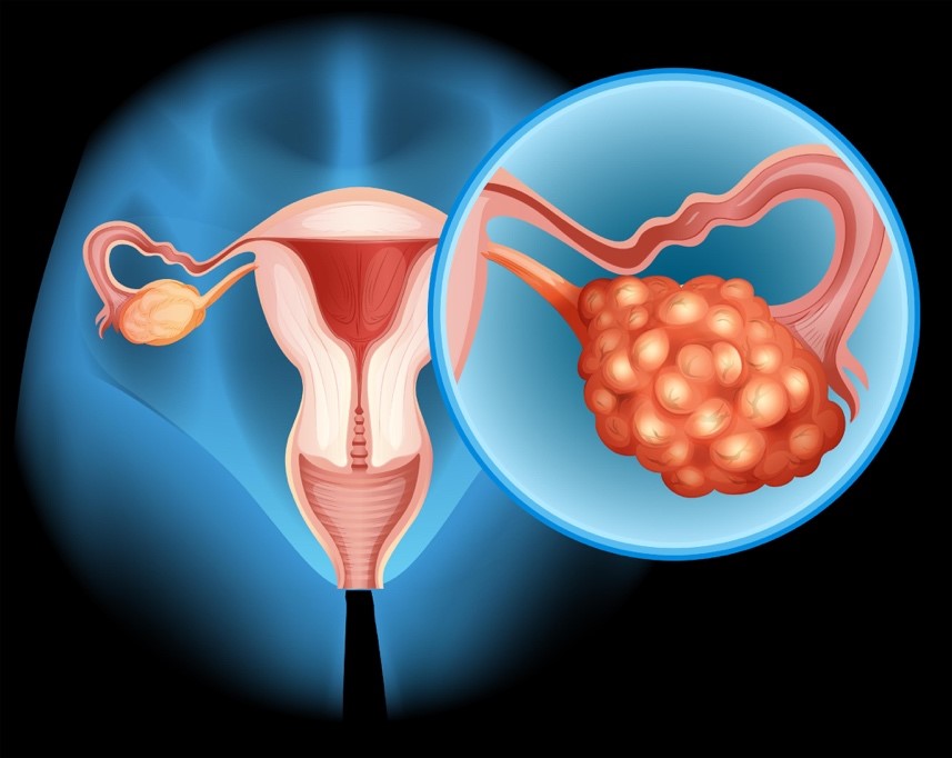 ovarian tumors